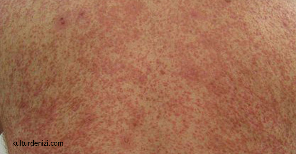 Purpura Nedir?
